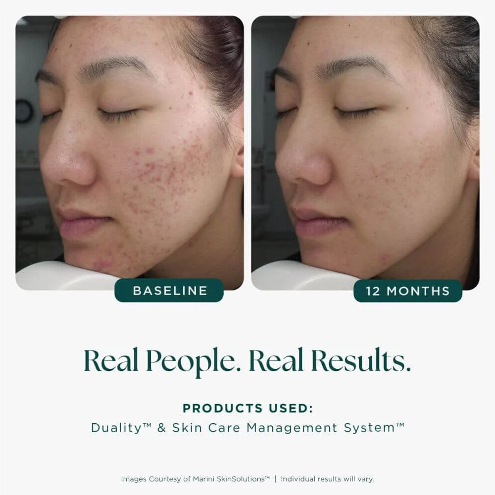 Marini Skin Solutions Duality Acne Treatment Cream - Image 7