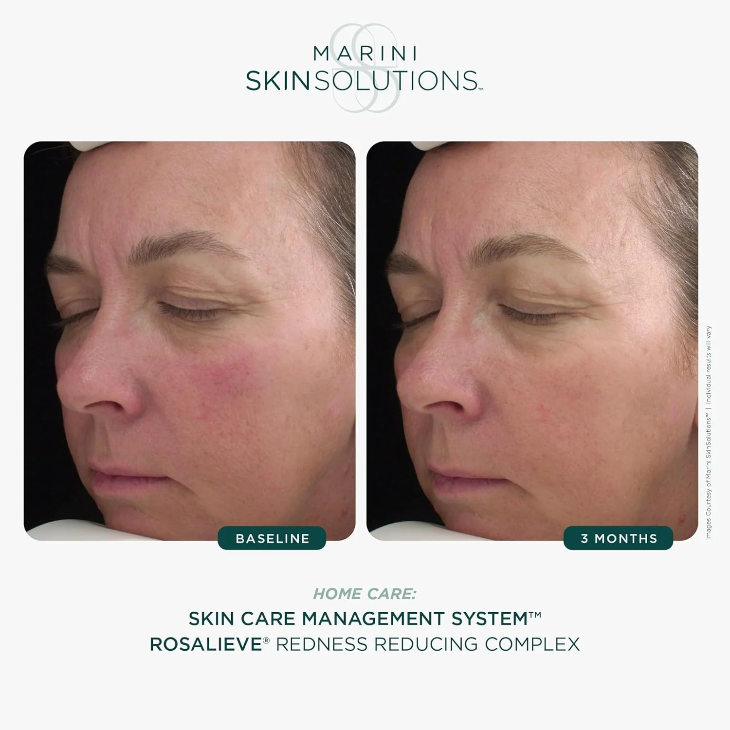Marini Skin Solutions RosaLieve Redness Reducing Complex - Image 4