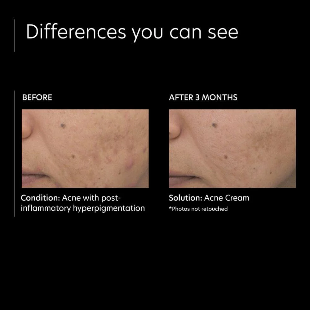 PCA Skin Acne Cream - Image 5