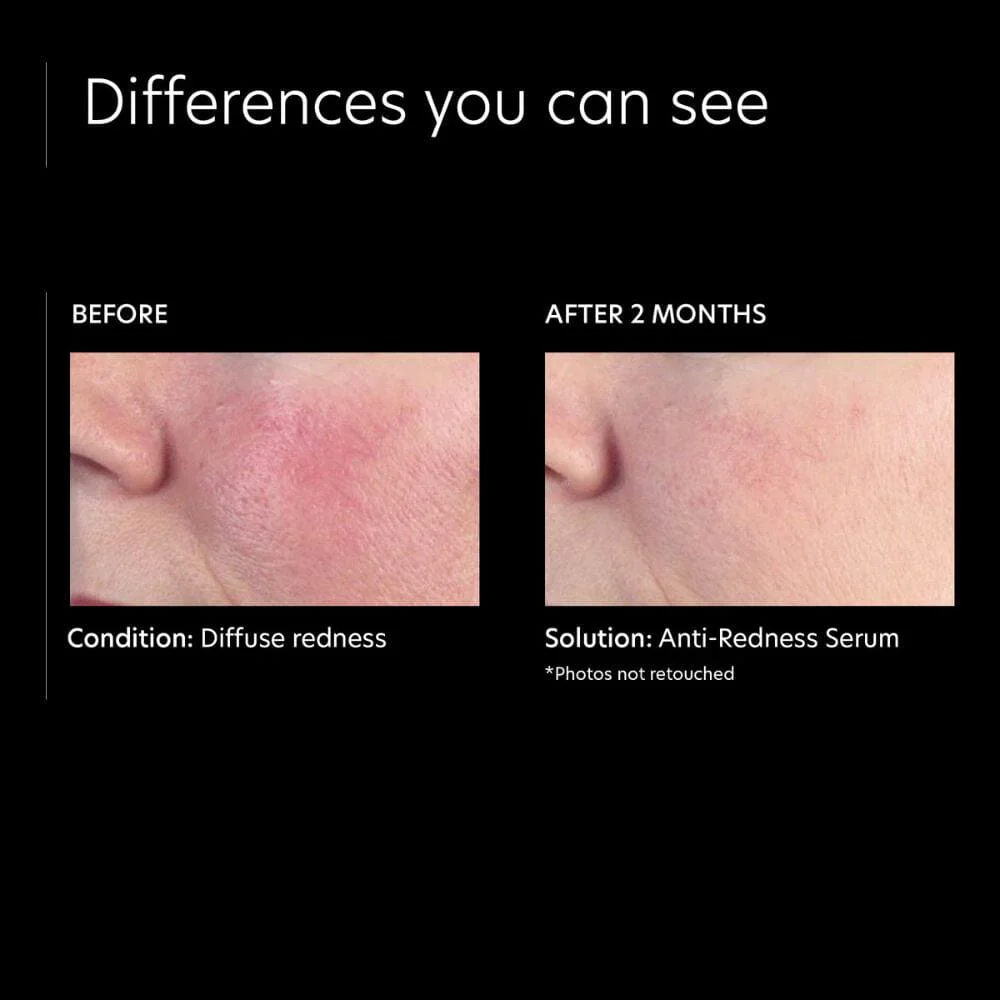 PCA Skin Anti-Redness Serum - Image 6