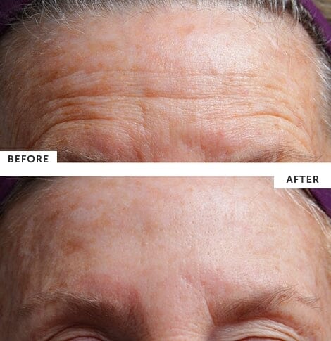 SilcSkin Facial Pads (Brow Set) - Image 3